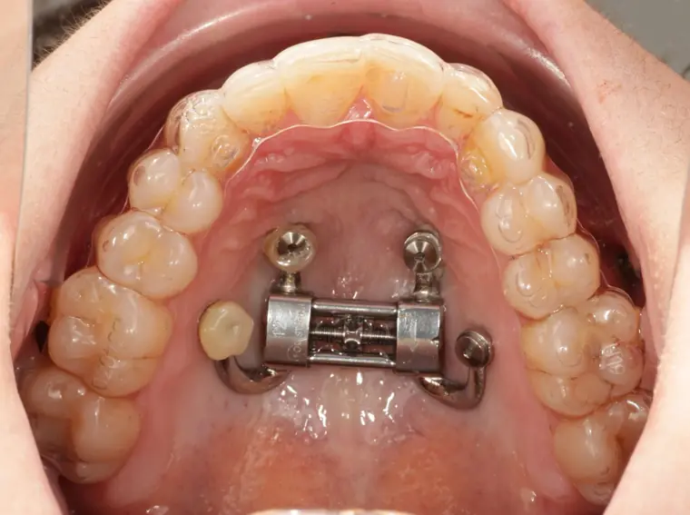 DOMEzero palatal expander shown with clear aligners at Toothpillow Breathing & Sleep Center in Draper, Utah